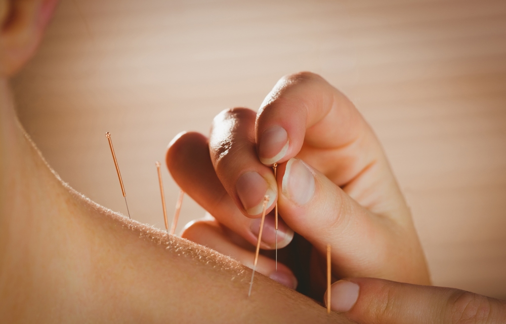 Chinese Acupuncture – An Ancient Art For A Modern Age